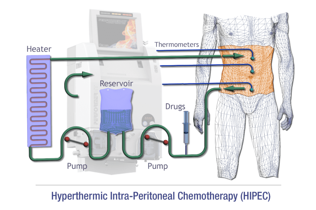 HIPEC